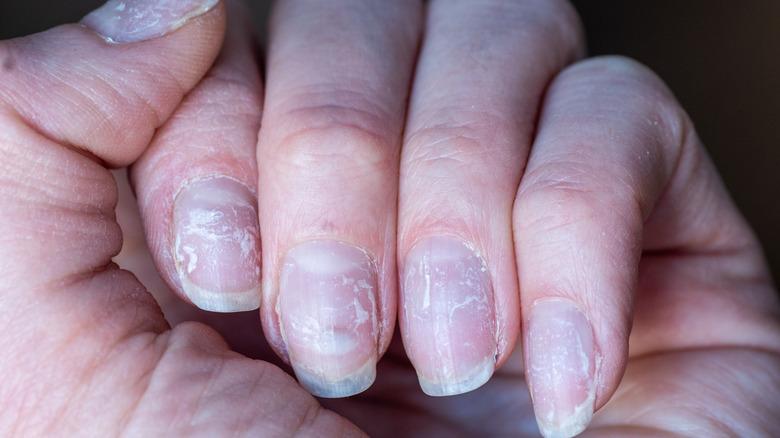 close up of dry and brittle nails