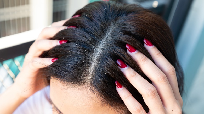 girl with dandruff touching hair