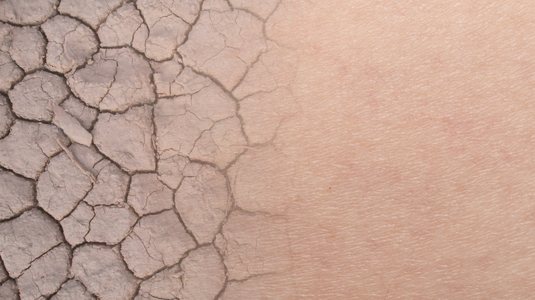 dry cracked skin to hydration