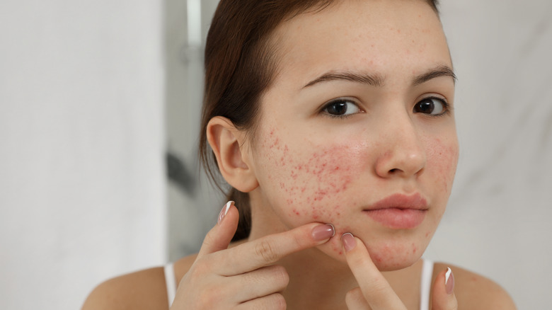 Young woman touching acne-prone face