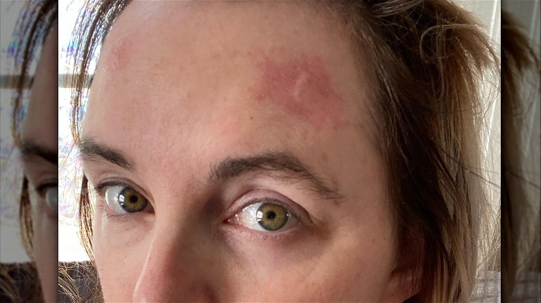 Woman with actinic keratosis on forehead