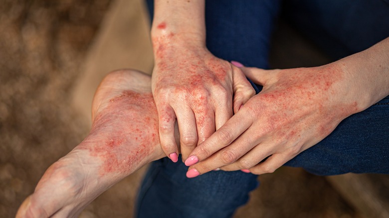 Person with atopic dermatitis on hands and feet