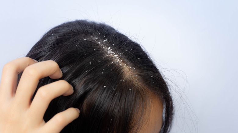 Woman with dandruff