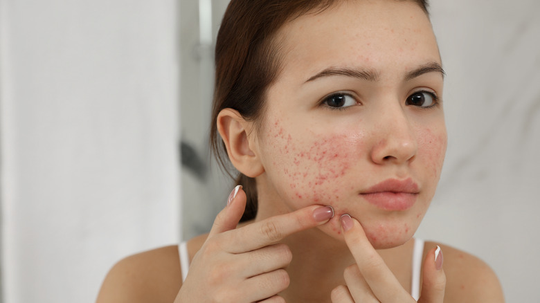 Woman with acne picks at her face