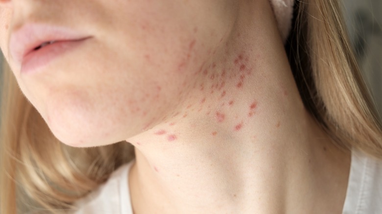 Woman's face with acne along jawline