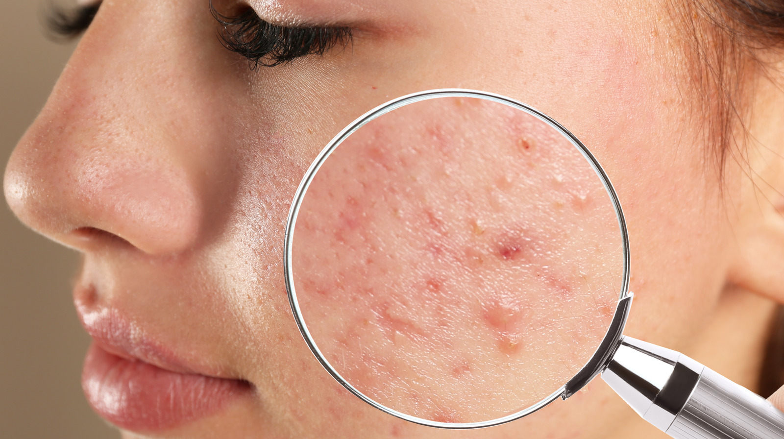 Acne Scars And Dark Spots What Are They And How Do You Get Rid Of Them 