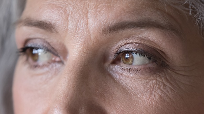 Woman with dry eyelids