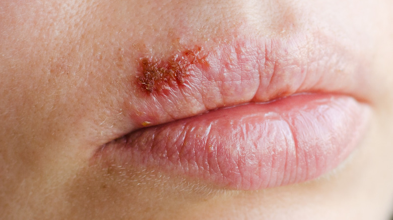 Lips with cold sore