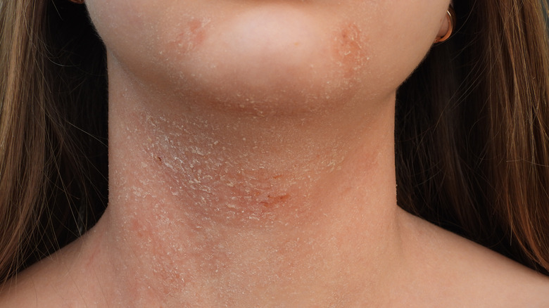 Atopic dermatitis on neck 