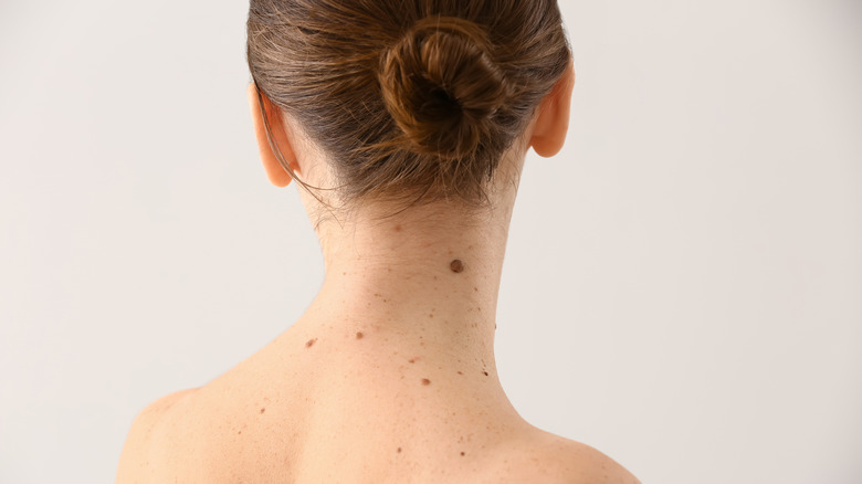 Woman with moles 