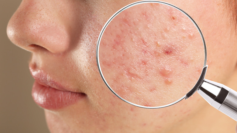 Closeup of woman's cheek with acne