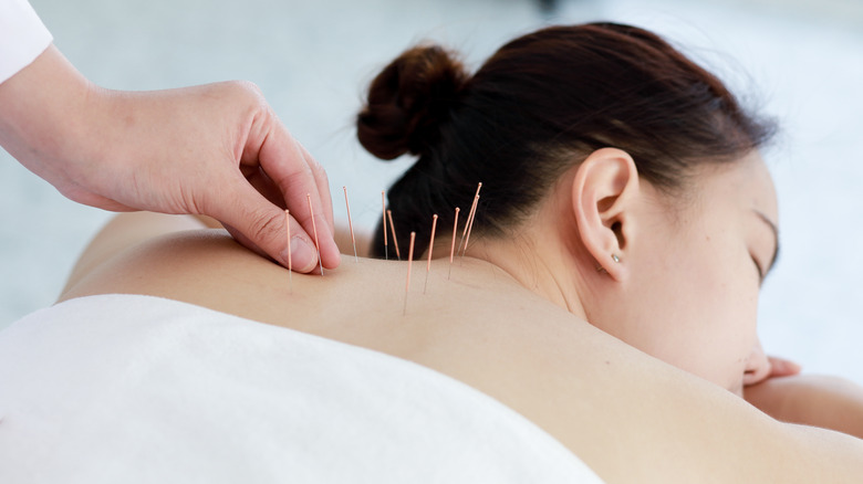 Woman having acupuncture treatment