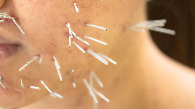 acupuncture needles in cheek with acne