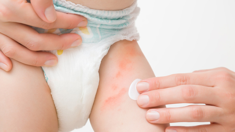 Infants get eczema as well