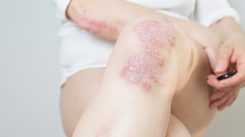 acute psoriasis on knees