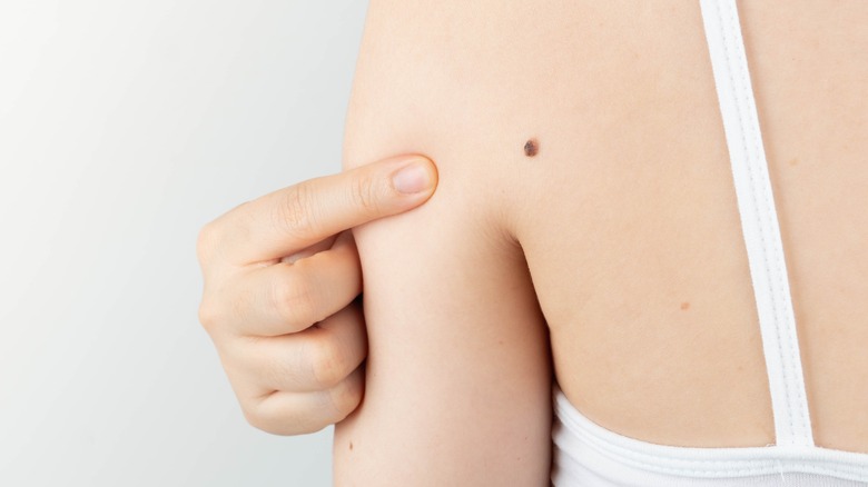 A woman pointing at her mole