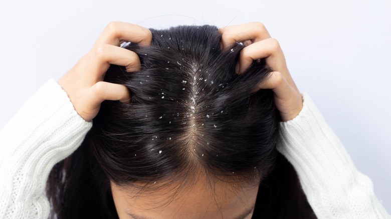 A woman with dandruff and itchy scalp