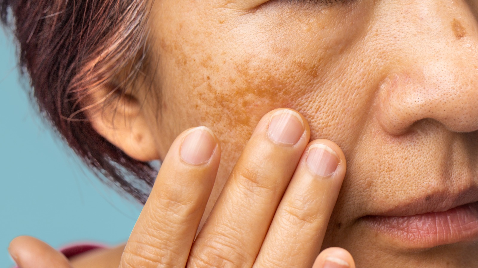 Musely melasma treatment