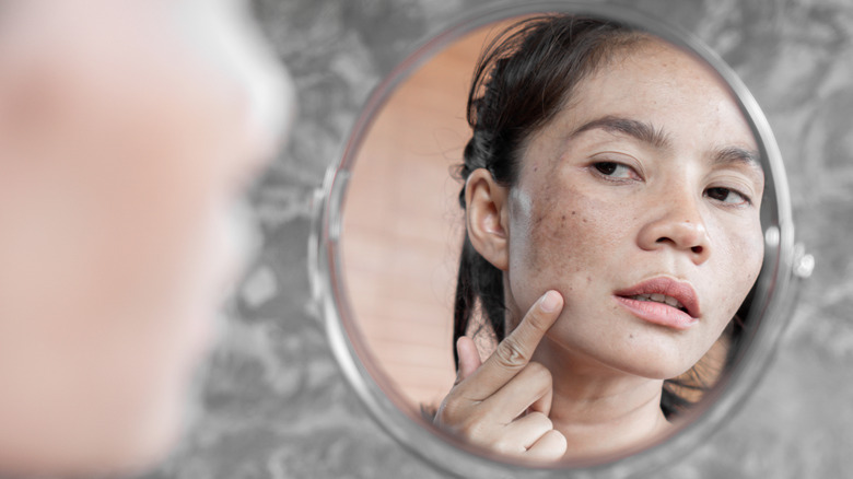 woman looking at melasma in mirror