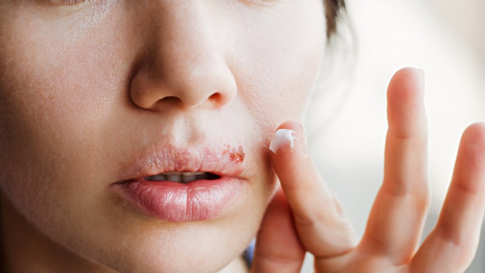 Woman applying cream onto a cold sore