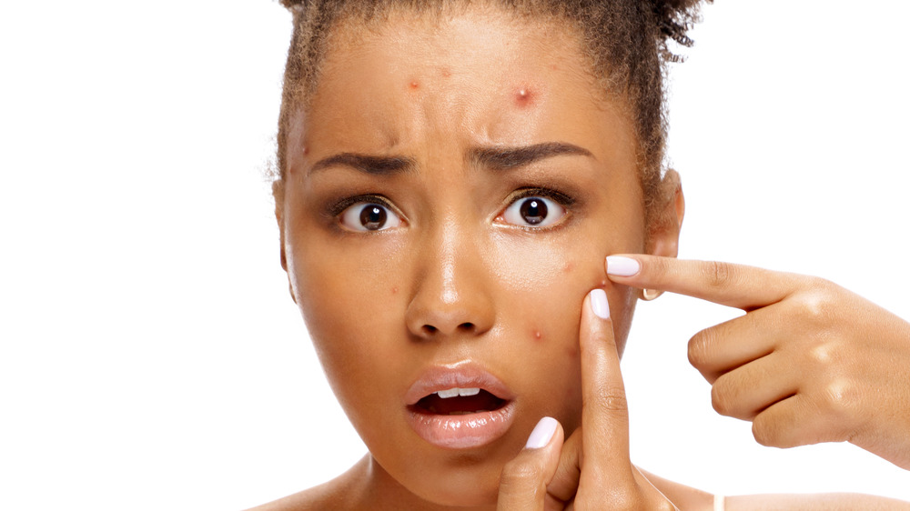 woman with acne on her forehead