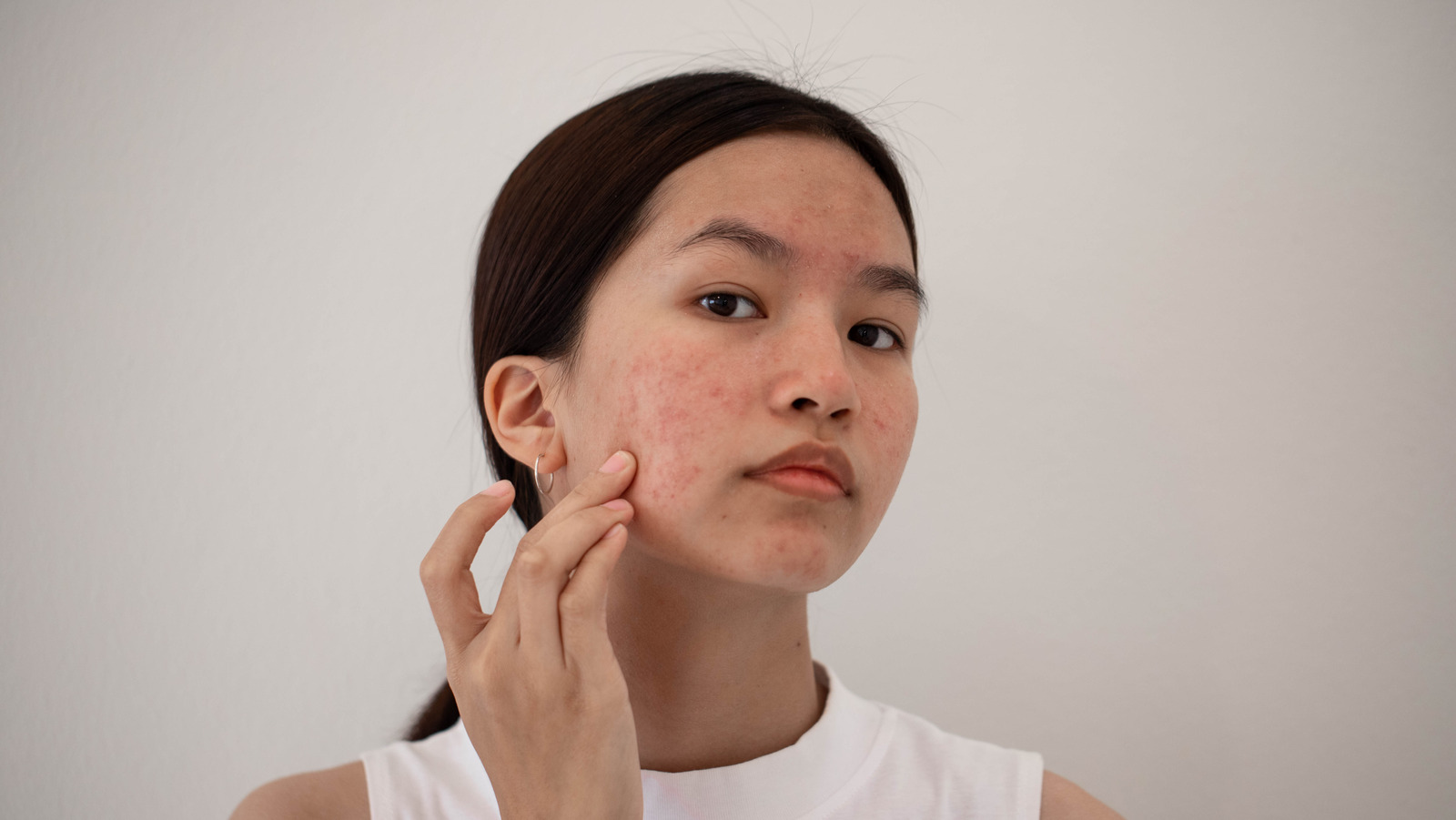 Does Amoxicillin Help Treat Acne?