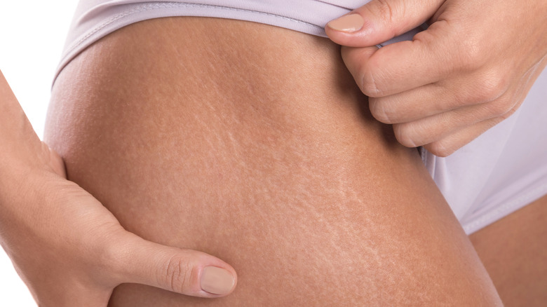 Woman with stretch marks on legs