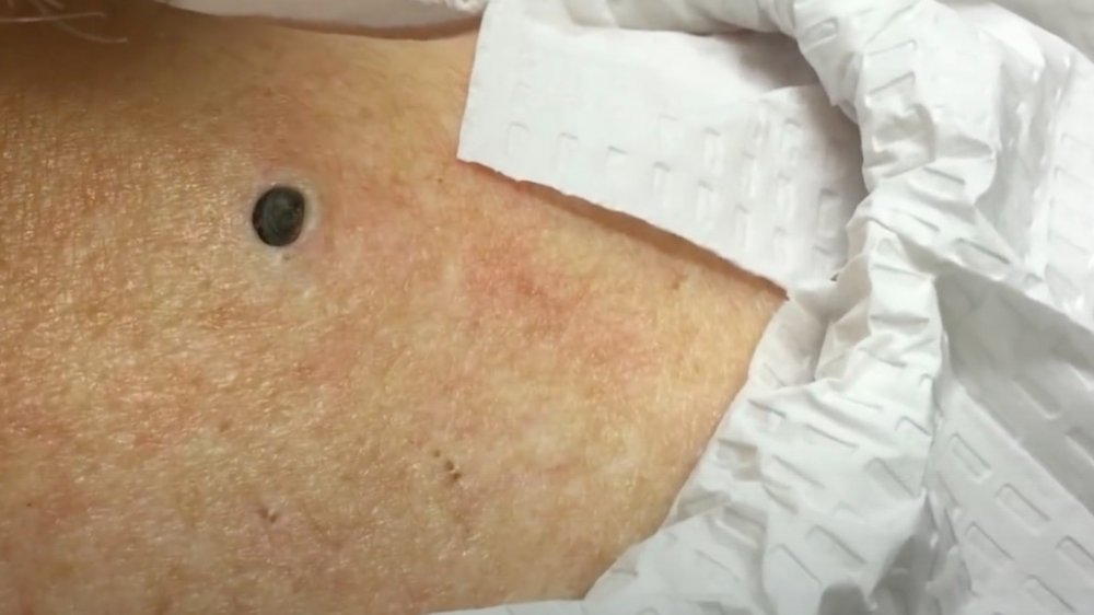 Dr. Pimple Popper's 85-year-old blackhead