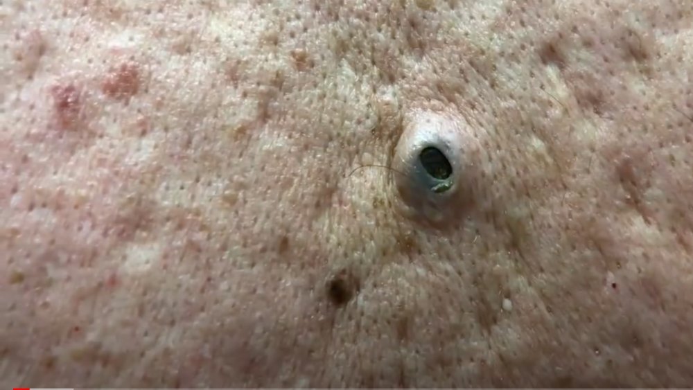 Dr. Pimple Popper's 30-year-old blackhead