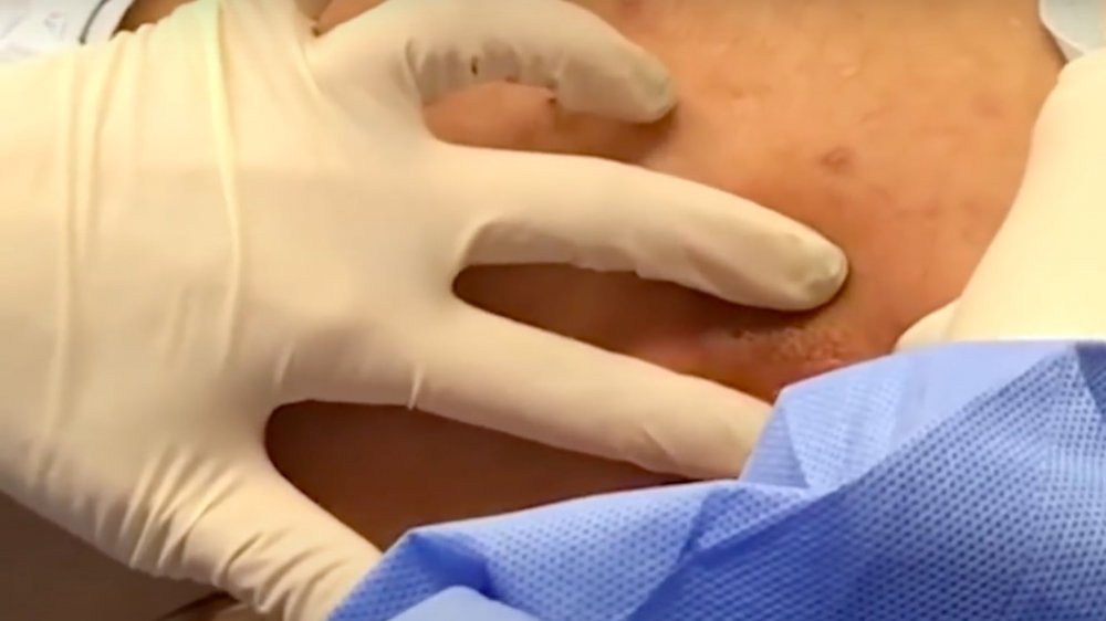 Dr. Pimple Popper's abscess waterfall