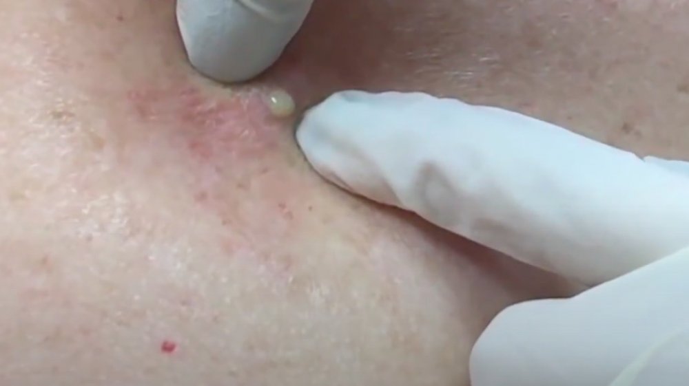 Dr. Pimple Popper's big back blackhead