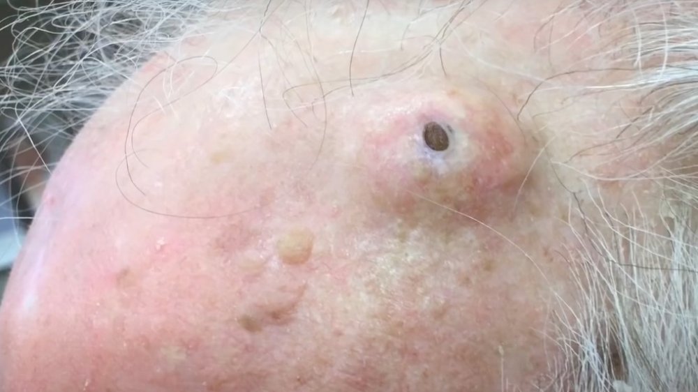 Dr. Pimple Popper's enormous dilated pore