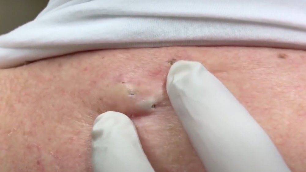 Dr. Pimple Popper's dialated pores of winer