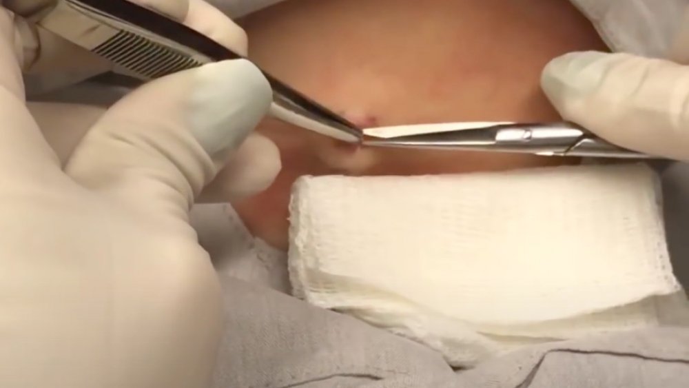 Dr. Pimple Popper's cheesy cyst