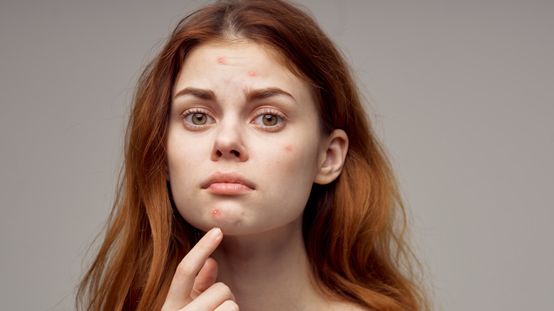 An unhappy woman pointing at her zits