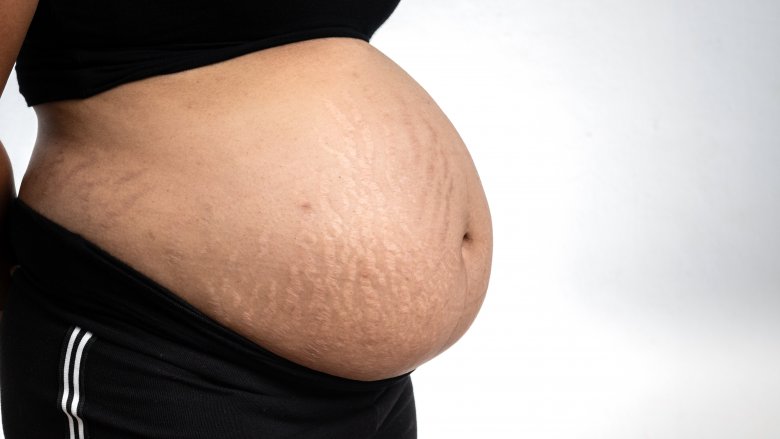 A pregnant belly with stretchmarks 