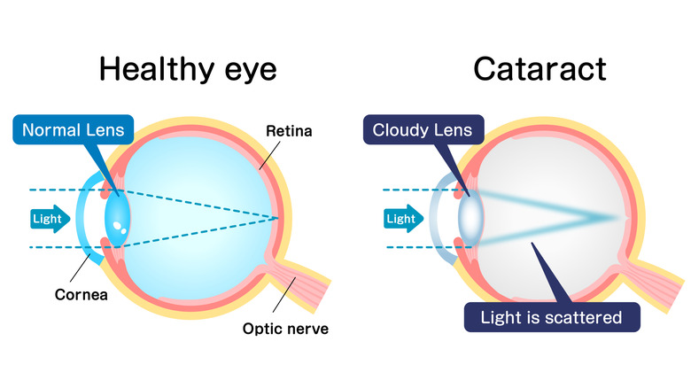 Diagrams of a healthy eye and one with a cataract