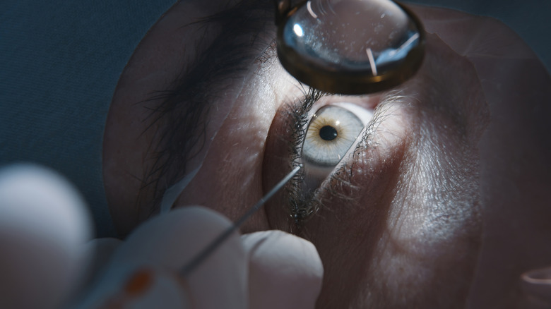 A close-up of an eye surgery