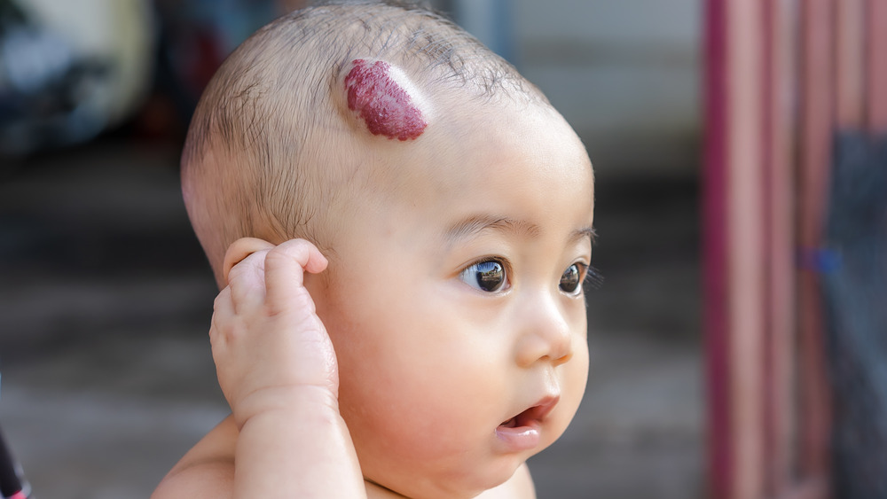 Baby with hemangioma