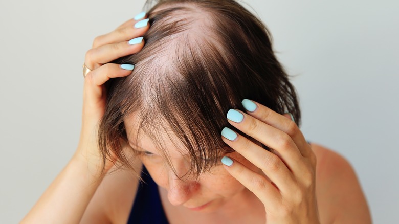 Woman holding head with bald patches