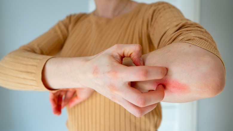 Woman scratching rash on elbow