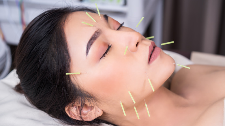 women with acupuncture in her face