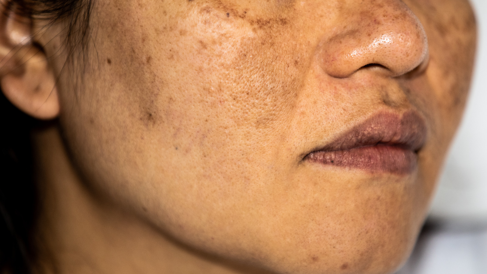 Heres How To Treat Hyperpigmentation Once And For All
