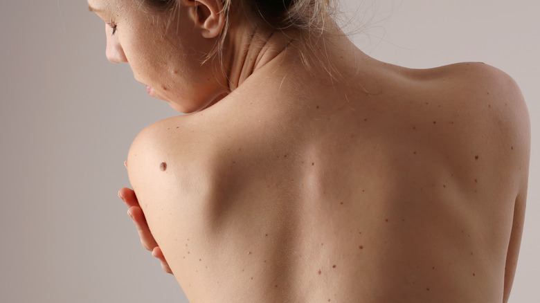 Woman with mole on shoulder