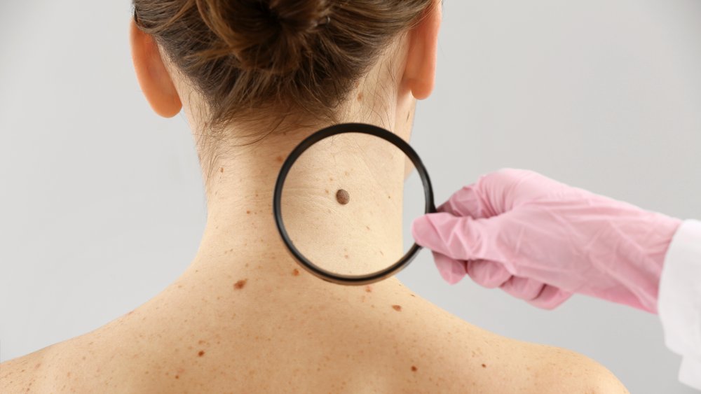 dermatologist examining moles on woman's back