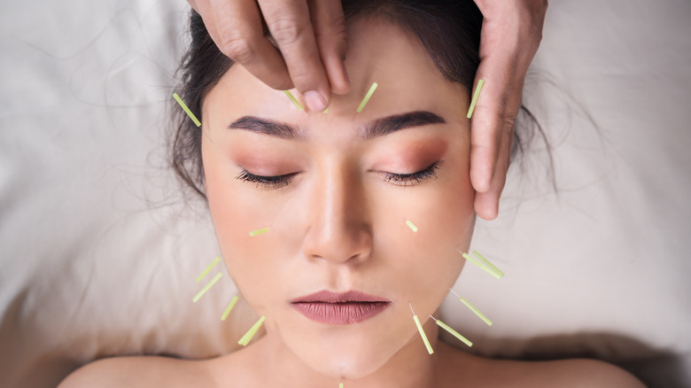 Acupuncture needles inserted in the face