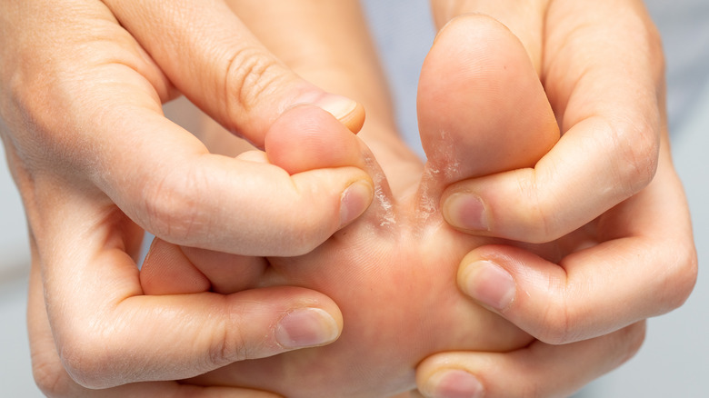 close up of athlete's foot