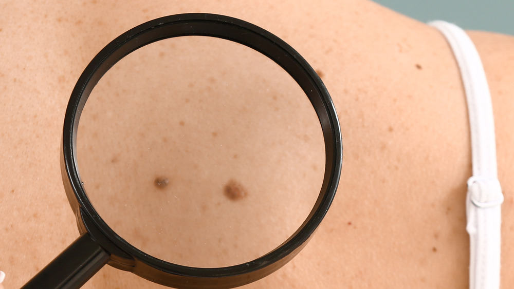 Heres What Having Twin Moles Can Tell You About Yourself