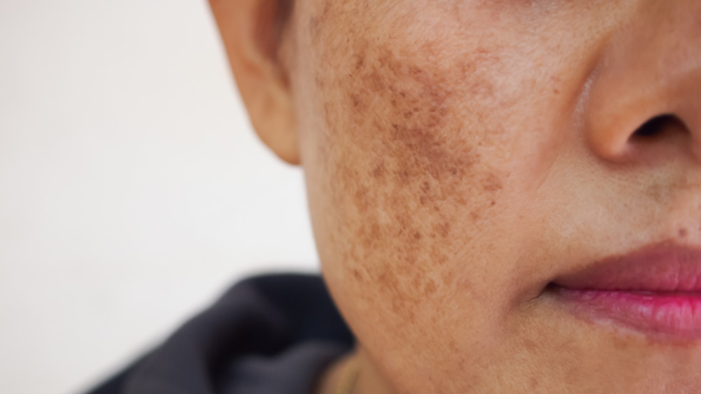 Woman with melasma on cheek