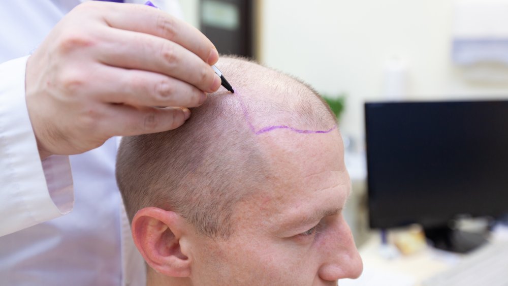 patient doing a hair loss consultation with a doctor 